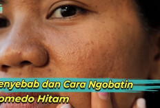 7 Faktor Pemicu Komedo yang Sering Diabaikan Namun Menjadi Biang Kerok Wajah Kusam dan Pori-Pori Tersumbat